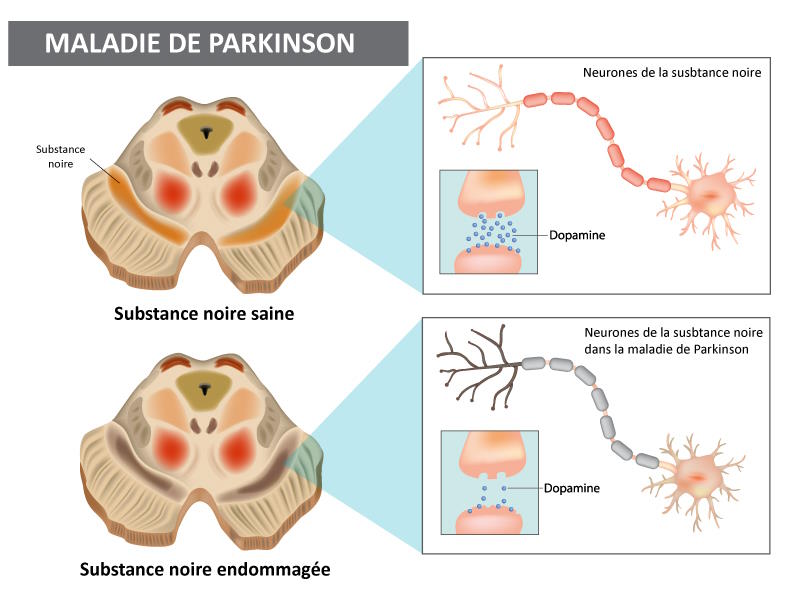 substance_noire_parkinson.jpg